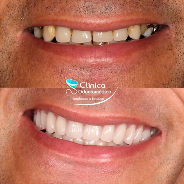 Caso Antes e Depois 8