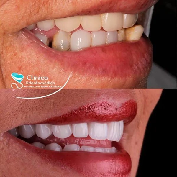 Caso Antes e Depois 9