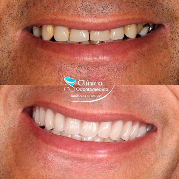 Antes-e-Depois-8.jpg